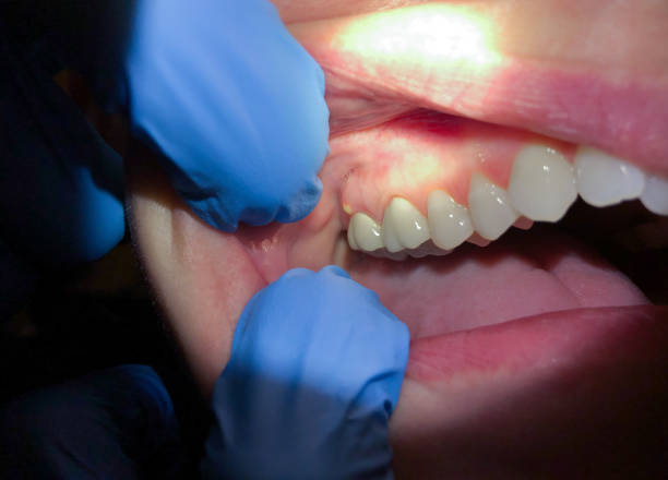 Tooth Infection Emergency Dentist in VA